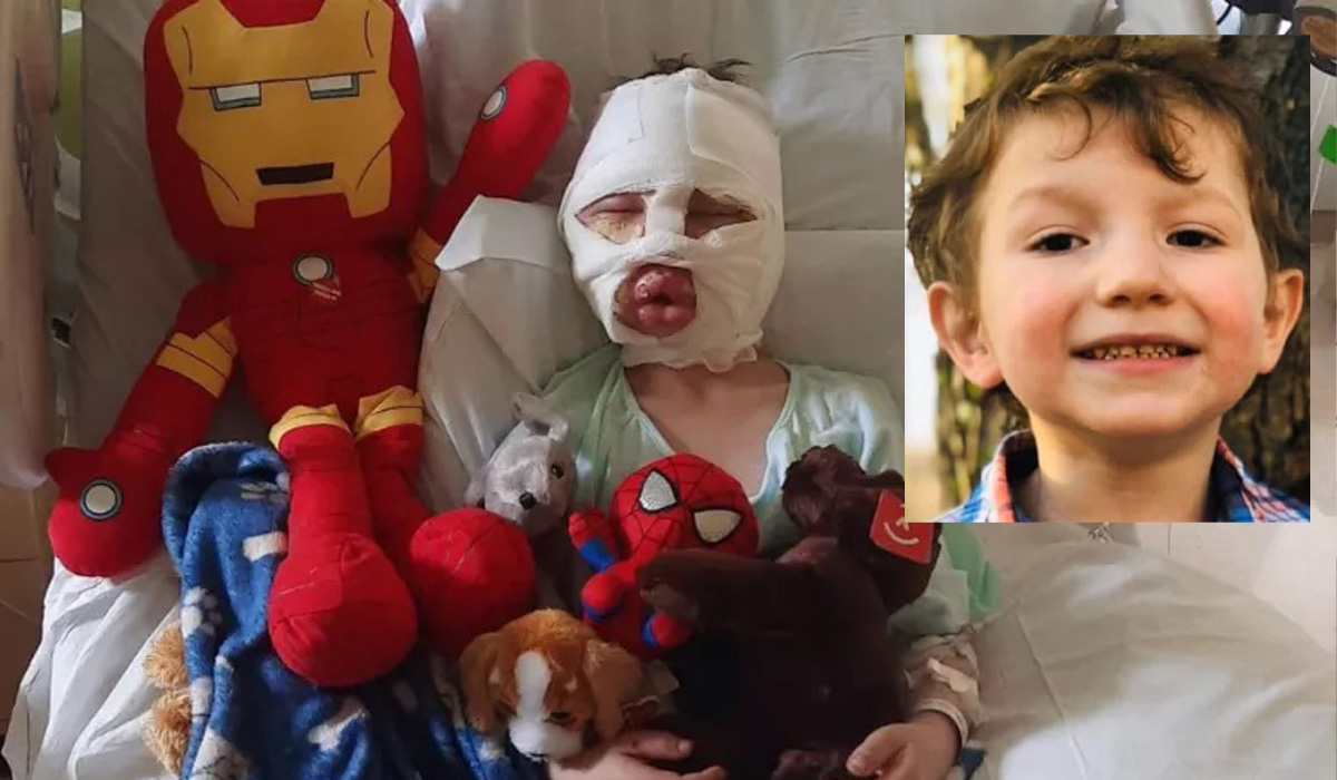 Read more about the article Bullying deixa menino de 6 anos com queimaduras de terceiro grau