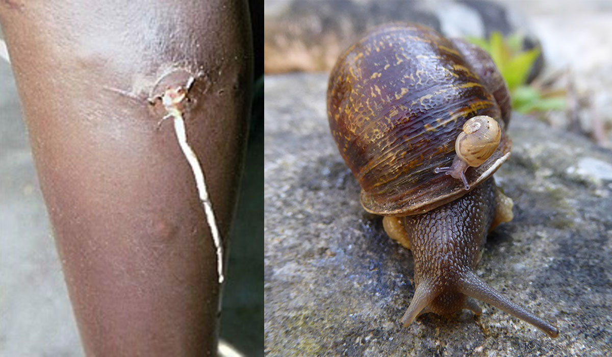 Read more about the article Febre do caracol: A nova doença que causa infertilidade e está a preocupar a OMS