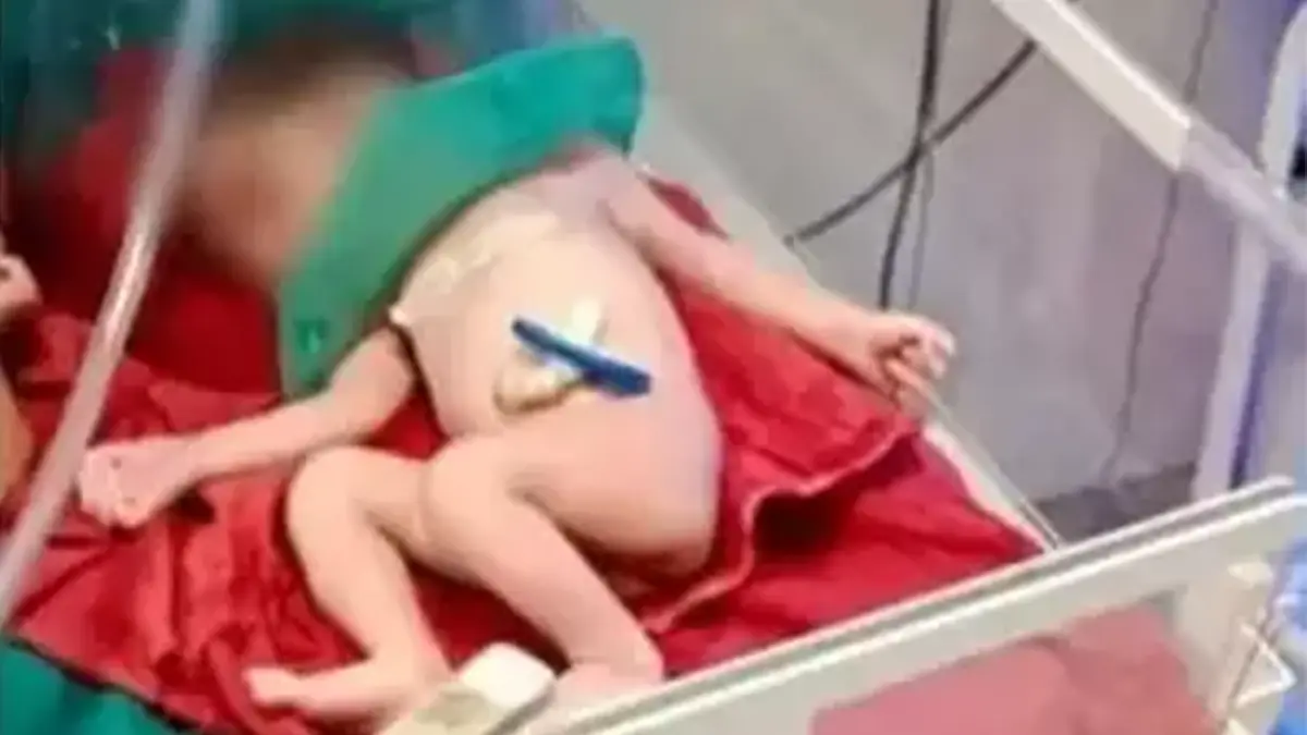 'Bebé milagre' nasce aos oito meses de gestação após mãe ser atropelada mortalmente